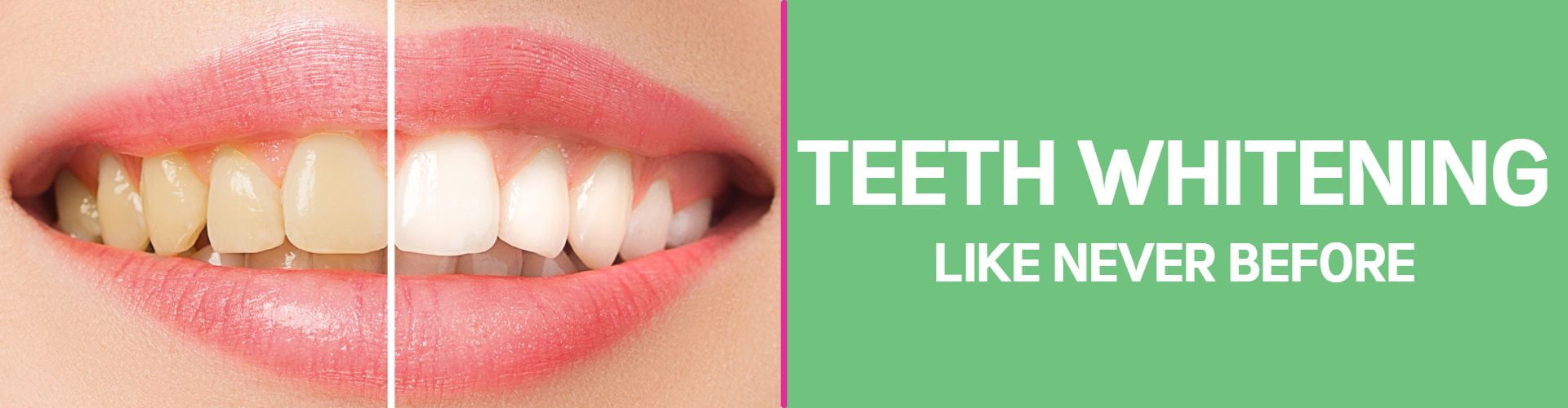 Teeth Whitening Noida