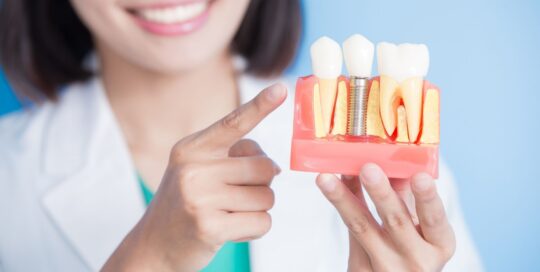 dental implants demonstration on a model