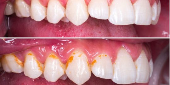 teeth cleaning and polishing results in rohini delhi