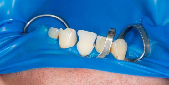 front teeth dental fillings in noida delhi