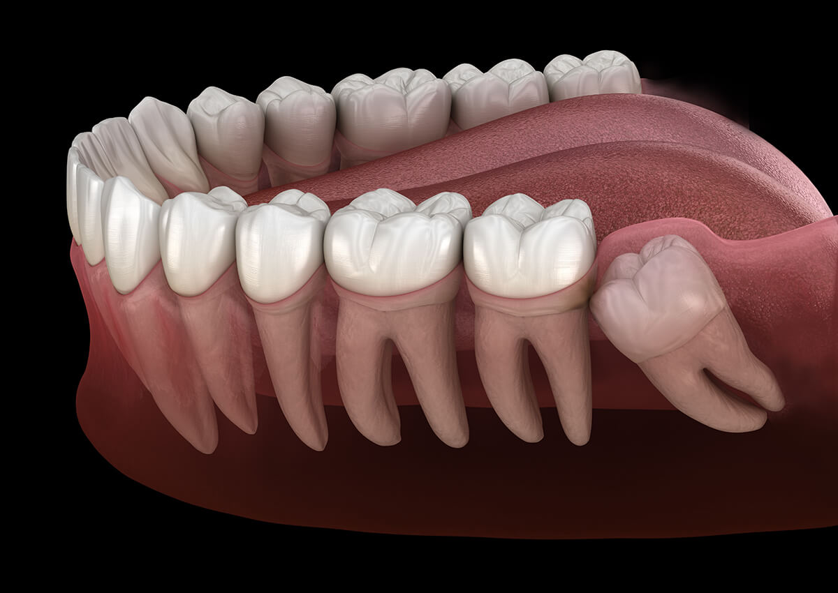 wisdom tooth removal in noida