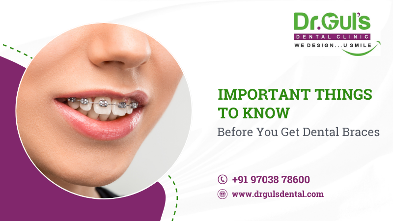 Dental Braces in Noida