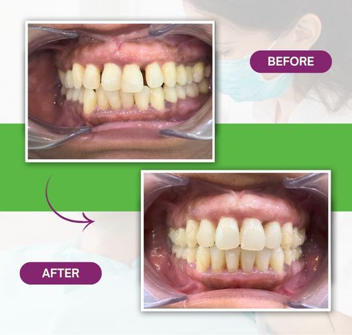 invisalign-braces-before-after-2