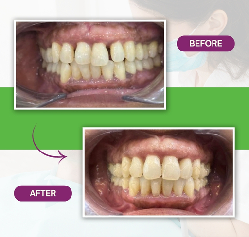 Template 02 – Before After – Dr Gul (512 x 488 px) (4)