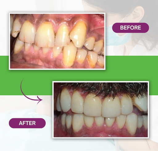Template 02 – Before After – Dr Gul (512 x 488 px) (6)