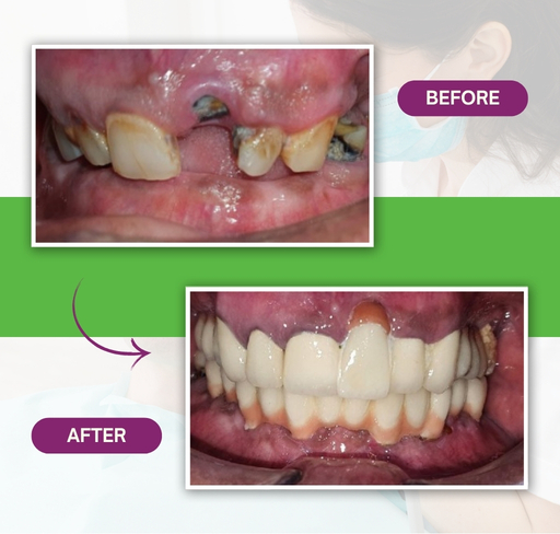 Template 02 – Before After – Dr Gul (512 x 488 px)